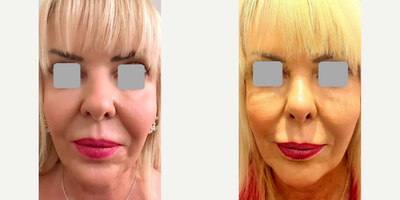Woman treated with Rhinoplasty, Alarplasty - Rhinoplasty + Alar base reduction - 3 months