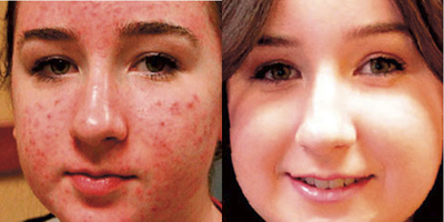 Woman treated with Forever Clear BBL 1 month post 3 treatments - Photo provided courtesy of Sciton, Inc.