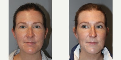 35-44 year old woman treated with Vampire Facial - Vampire Facial35 yo, F, 53, 120lbs, G1P1