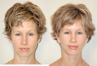 Before and After Cheek Lift (Front View) - 
	A cheek lift or mini-face lift is an excellent procedure to rejuvenate aging of the midface.&nbsp; It is best used in people with minimal signs of aging.&nbsp; In this patient, the procedure was chosen over more aggressive rejuvenation procedures because she has slight hollowness of the cheeks, minimal jowl formation, minimal prominence of the nasolabial folds, and an excellent aesthetic of the neck.

	The patient is shown 2 months postop.&nbsp; Note that the improvement is subtle, but natural looking, and achieves her goal of a more youthful appearance.
