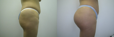 Woman treated with Butt Implants - Woman treated with Butt Implants for enlargement and reshaping of buttocks.
