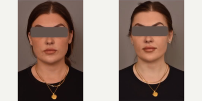 Woman treated with Buccal Fat Removal - Woman treated with Mini Neck Lift, Buccal Fat Removal, and Cheek Liposuction.