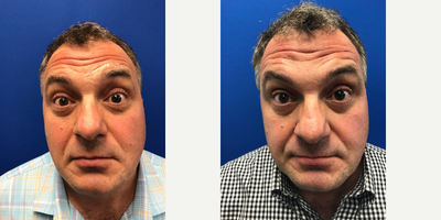 45-54 year old man treated with Botox - Botox for a 51 year old male. Combined with filler