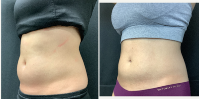 25-34 Woman: 1 Month Ozempic + Emsculpt Oblique View Ozempic before and after transformation