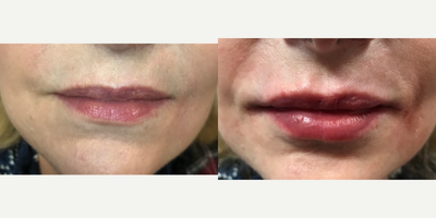 55-64 year old woman treated with Lip Augmentation - Lip augmentation with 1 syringe of Versa using blunt tipped cannula
