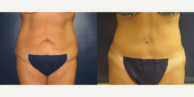 Mommy Makeover - 49 year old woman underwent a tummy tuck, breast lift and augmentation with 339cc silicone implants by Dr. Peter Butler.