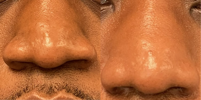 25-34 year old man treated with African American Rhinoplasty - 28 year old male underwent Alarplasty surgery under local anesthesia.