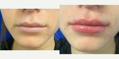 18-24 year old woman treated with Volbella - Volbella lip filler immediately after injection. By Steve