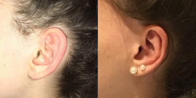 18-24 year old woman treated with Ear Lobe Surgery - Patient wanted ears made smaller and even