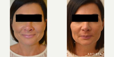 42 year old woman treated with Rhinoplasty - 42 year old woman treated with Rhinoplasty.