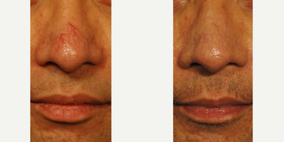Laser spider vein removal on the nose, Los Angeles before and after photos. - Spider veins on the face can be a concerning condition, especially when they are on the tip of the nose.  Laser treatments are a great option to keep these kinds of veins under control.