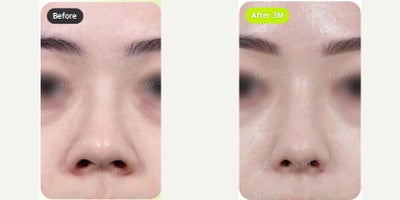 25-34 year old woman treated with Alarplasty - 25-34 year old woman treated with Alarplasty