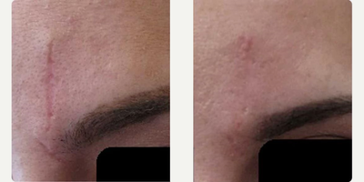 Woman treated with Secret RF - Woman treated with Secret RF.