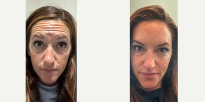 35-44 year old woman treated with Jeuveau - This client had several areas treated with Jeuveau. We treated the forhead, glabella, bunny lines and crows feet.