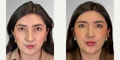 25-34 year old woman treated with Facial - Our patient presented with a deviated and enlarged nose (rhinomegaly), a dorsal hump, a high radix, and a drooping, asymmetrical nasal tip lacking proper support. We performed a personalized rhinoplasty to restore balance, structure, and harmony to her facial features. To further enhance the overall result, her treatment was complemented with CO2 laser to improve skin quality, along with hyaluronic acid in the chin and lips, achieving a more refined, aesthetic, and harmonious outcome.