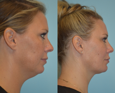 35-44 year old woman treated with ThermiSmooth Face - 35-44 year old woman treated with Thermi RF and Liposculpture. Her result reveals a natural, contoured jawline.