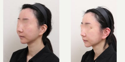 35-44 year old woman treated with AccuLift, Liposuction - 38 Years old female patientChief Complain: Face assymetry, bukly faceTreatment Plan: ACCU facial liposuctionOutcome: Smooth face line, less visible asymmetry, balanced face shape