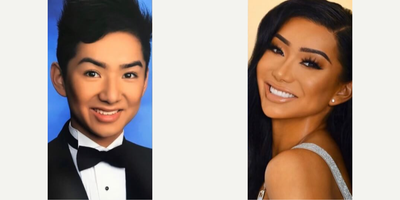 Woman treated with Facial Feminization Surgery - Woman treated with Facial Feminization Surgery
