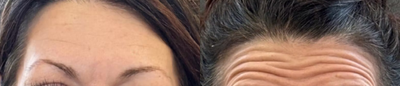 Woman treated with Botox - Woman treated with Botox