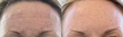 Woman treated with Botox - Woman treated with Botox