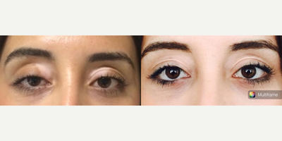 Woman treated with Ptosis Surgery - This patient underwent right scarless ptosis surgery.