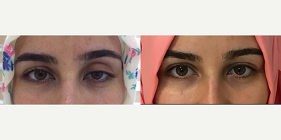 Woman treated with Ptosis Surgery - Pre and post-op photos og a patient who underwent scarless ptosis surgery.