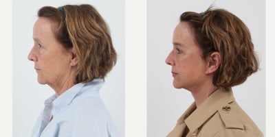 65-74 year old woman treated with Facelift, Neck Lift, Brow Lift, Eyelid Surgery, Facial Fat Transfer, CO2 Laser - 70 year old 3 months after a Facelift, Neck lift, brow lift, upper and lower bleph, fat transfer and co2 laser by Dr. Dilip D. Madnani.