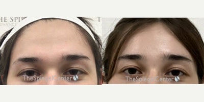 18-24 year old woman treated with Forehead Reduction - 18-24 year old woman treated with Forehead Reduction