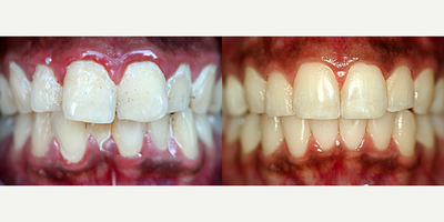 Invisalign - Invisalign