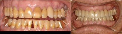 Closing black triangles between teeth - This gentleman had some periodontal treatment that left gaps and dark triangles between his teeth.&nbsp; By placing crowns and veneers on his teeth, he was able to make the teeth have a much more esthetic look and at the same time made his teeth easier to clean.&nbsp; Trapping food was a problem that he no longer has!