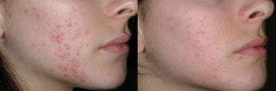 Acne and Isolaz - 23 year old female treated with 5 sessions of Isolaz