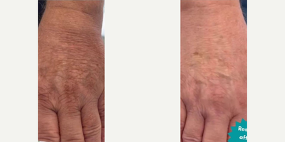 Woman treated with Mesotherapy - Woman treated with Mesotherapy