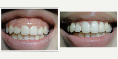 18-24 year old woman treated with Gum Lift - 23 year old Asian female who presented with a gummy smile and low self-confidence. Her options were to perform a gum lift procedure or jaw surgery to improve the proportion of gum v. tooth that she shows. She wanted to show more tooth when she smiles after treatment. Typically, the gum lift procedure is the more conservative of the two treatments so that was performed first with the option that should she be unhappy with the result, she could proceed to jaw realignment surgery (LeFort Osteotomy).