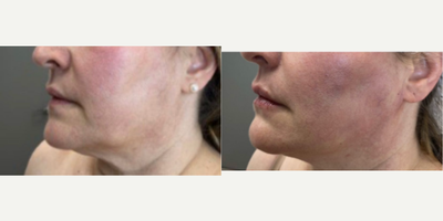Threadlift for jowls - A nice lift with a thread lift.