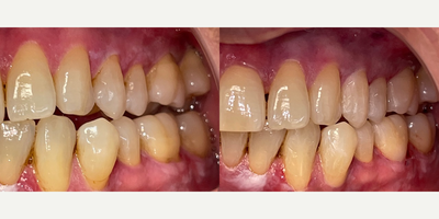 35-44 year old man treated with Dental Bonding - 41 year old man treated with Dental Bonding