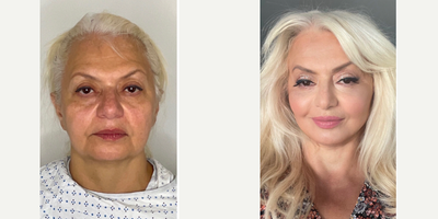 55-64 year old woman treated with Deep Plane Facelift, Eyelid Surgery - 62-year-old female who underwent deep plane facelift and neck lift along with lower blepharoplasty. She is now one month postop from the surgery. The whole surgery was performed under local anesthesia.