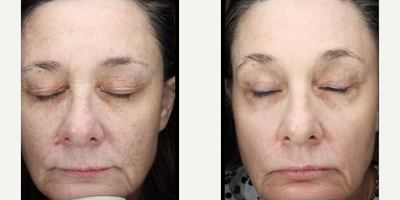 Woman treated with Scar Removal, Laser Scar Removal - Woman treated with Laser Resurfacing.