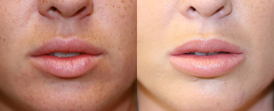 Lip Augmentation with Permalip by Surgisil - Before picture shows lip augmentation with HA filler, which has resorbed and been replaced by Permalip (Surgisil) 5mm implants in after picture.