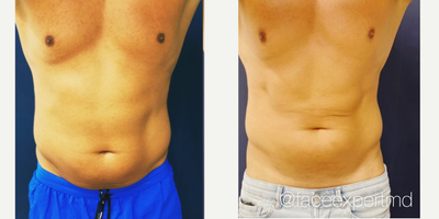 45-54 year old man treated with truBody - truBody by Dr. Arash Moradzadeh