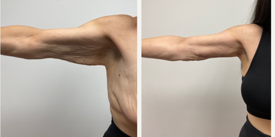 55-64 year old woman treated with Arm Lift - 8 weeks after a bilateral brachioplasty