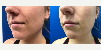 25-34 year old woman treated with Facial Fat Transfer - Lips are hot these days!