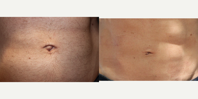 35-44 year old man treated with Belly Button Surgery - Umbilicoplasty                    42 y/o MContact us Today at 203-221-0102 for Your Umbilicoplasty Consultation!