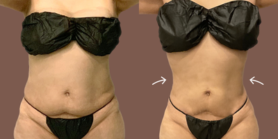 35-44 year old woman treated with AirSculpt, AirSculpt+ - The patient with a c-section scar came to AirSculpt looking to achieve a more hourglass figure. We were able to help remove the fat while skin tightening with Airsculpt+ around the patient's c-section scar. Results are at 6 months post-op.