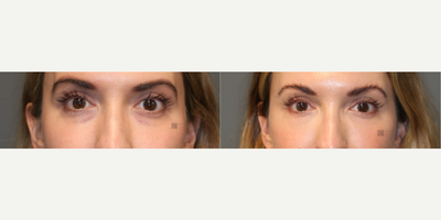 Woman treated with Restylane Silk - Filler to temples, eyes and microneedling with PRP