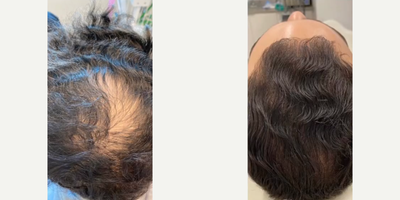 Man treated with PRP for Hair Loss - Less hair in your hand & more on your head. The results speak for themselves.