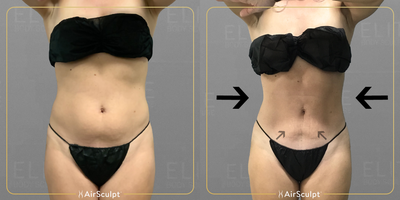 35-44 year old woman treated with AirSculpt - Six months after her Stomach and Back AirSculpt procedure, this Sacramento patient enjoys a significantly slimmer figure 360 degrees around her midsection, not to mention the love handles and muffin top she sculpted away for good!