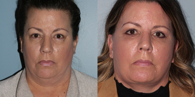 45-54 year old woman treated with Lifestyle Lift - Our 51-year-old patient was treated with Dr. Nichter's Litelift facelift which is similar to the Lifestyle Lift. This modified version of a traditional facelift addresses the lower portion of the face. It is lighter on incisions, anesthesia, and recovery. She wanted a conservative natural result which was achieved.