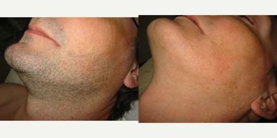 35-44 year old man treated with Botox - Patient wanted laser hair removal face. This is before and after 5 treatments.