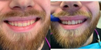 25-34 year old man treated with Gum Lift - We laser off the excessive gingival - gum - tissue and those teeth now sparkle!