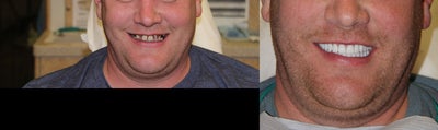 All-on-4 Dental Implants - The All-on-4 is the modern solution for all missing teeth. This treatment concept replaces your missing teeth with a Full Dental Bridge, No Palate, No Excess Material, Not Removable, and supported by only Four Specialty Dental Implants, with two of the Implants placed at precise angles. With less implants needed, overall treatment time is reduced. The unique All-on-4 solution also ensures greater stability in the bone, reducing the need for bone graft surgery to increase bone volume. Your teeth will look, feel and are brushed much like natural teeth, and you can lead a normal life immediately after a 1 Day surgery. Studies indicate that Patients receive 90-95% chewing ability. Your quality of life is improved and you can start enjoying your favorite foods again.